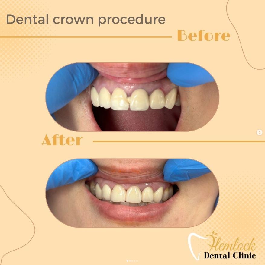 Crown-1.jpg