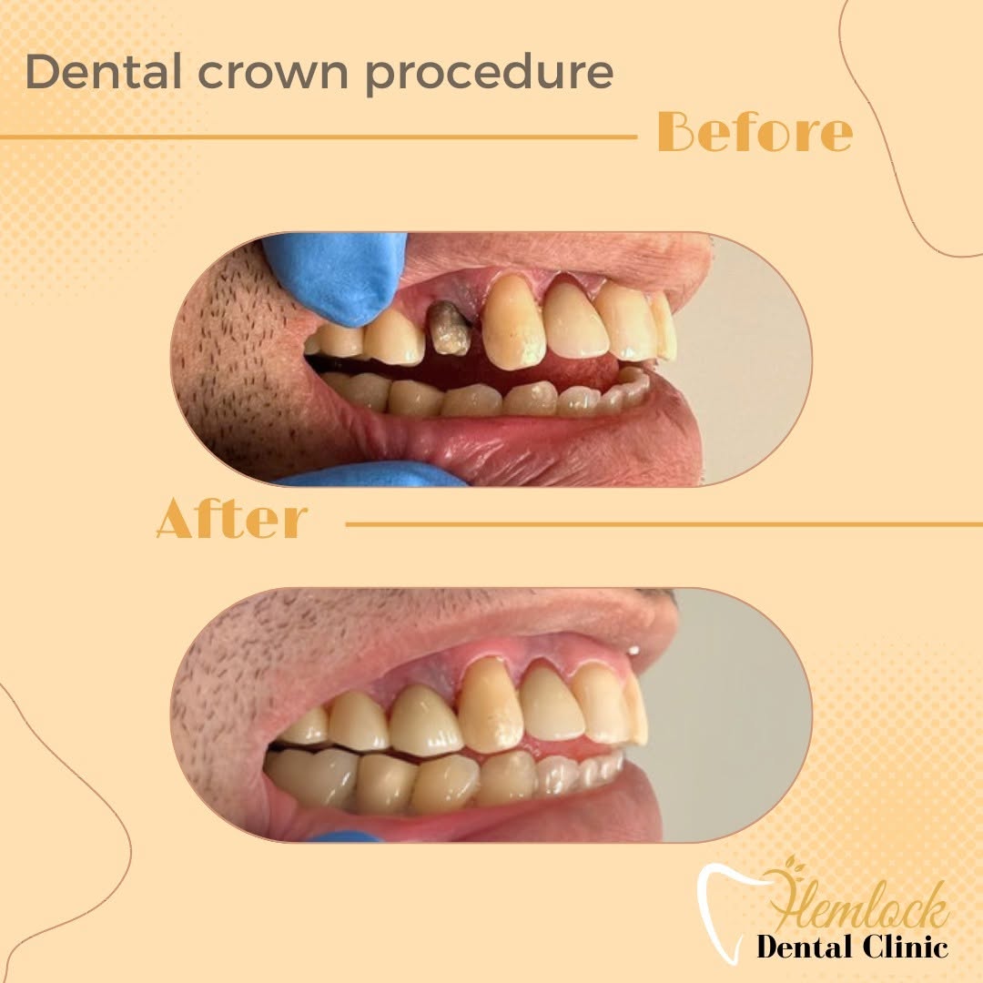 Crown-2.jpg