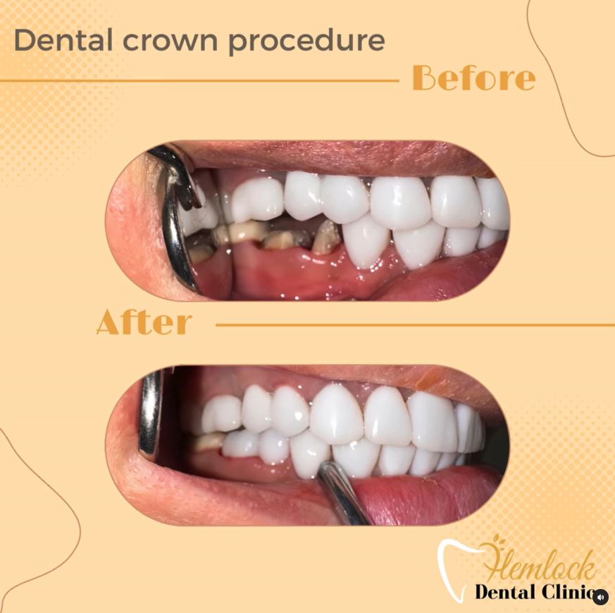 Crown-3.jpg